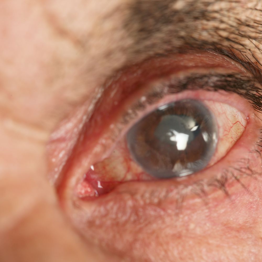 Glaucoma